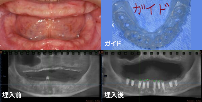 上下総入れ歯の患者の治療例
