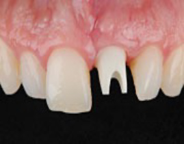 ジルコニアの歯と歯肉の境目の審美性を追求した「ジルコニアアバットメント」