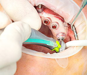 局部麻酔をして、ガイドに沿って歯肉に小さな穴をあけ手術