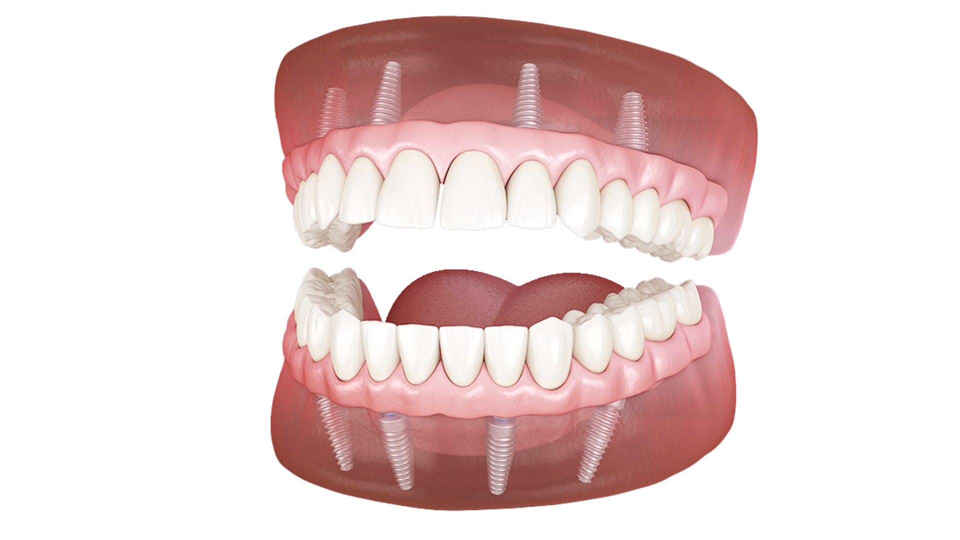 入れ歯よさようなら 一日でぼろぼろ歯が蘇る オールオン4